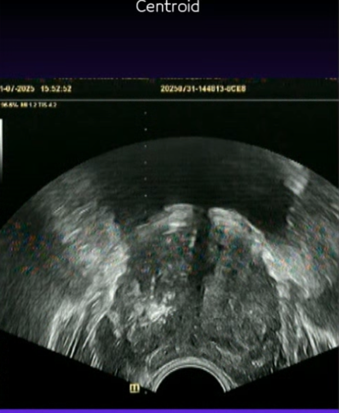 Prostat Füzyon Biyopsi